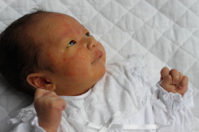 赤ちゃんの黄疸って何 治療が必要と言われたときの対応は 子育てラボ